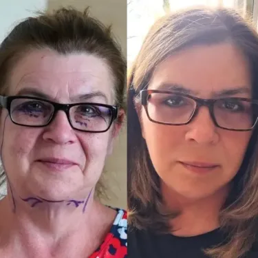 Ліфтинг обличчя в Туреччині