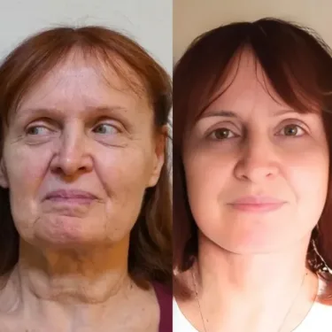 Ліфтинг обличчя в Туреччині