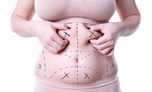 liposuction in a Turkish clinic