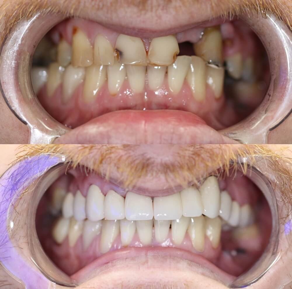 Implantación dental