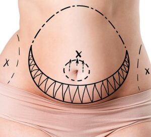tummy tuck after pregnancy