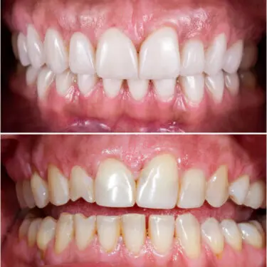 Zahnaufhellung, Restauration, Implantation