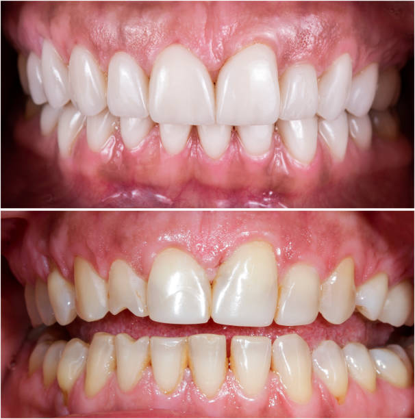 Whitening, teeth restoration