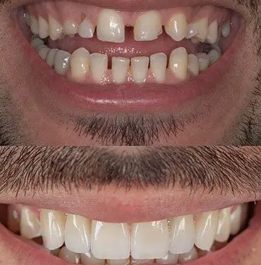 Zahnaufhellung, Restauration, Implantation