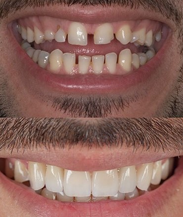 Імплантація зубів