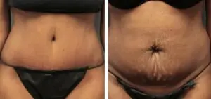 abdominal correction after childbirth