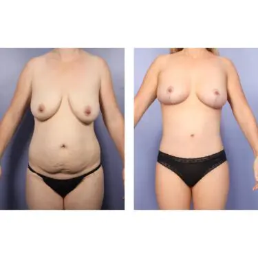 Mommy Makeover in Turkey