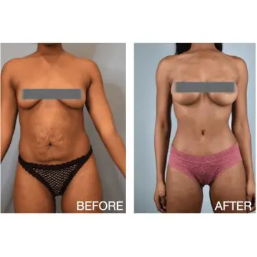 Mommy Makeover in Turkey