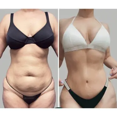 Mommy Makeover in Turkey