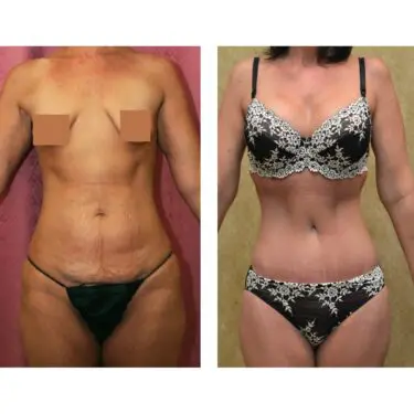 Mommy Makeover in Turkey