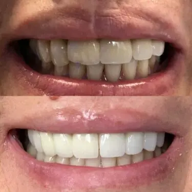 Zahnaufhellung, Restauration, Implantation