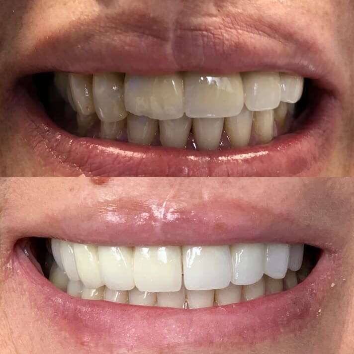 Whitening, teeth restoration
