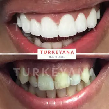 Zahnveneers