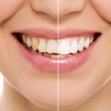 Отбеливание зубов