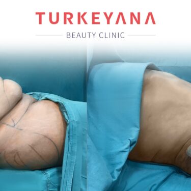Abdominoplastia en Turquía