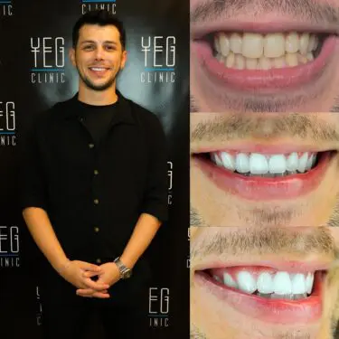 Implants dentaires, Hollywood Smile