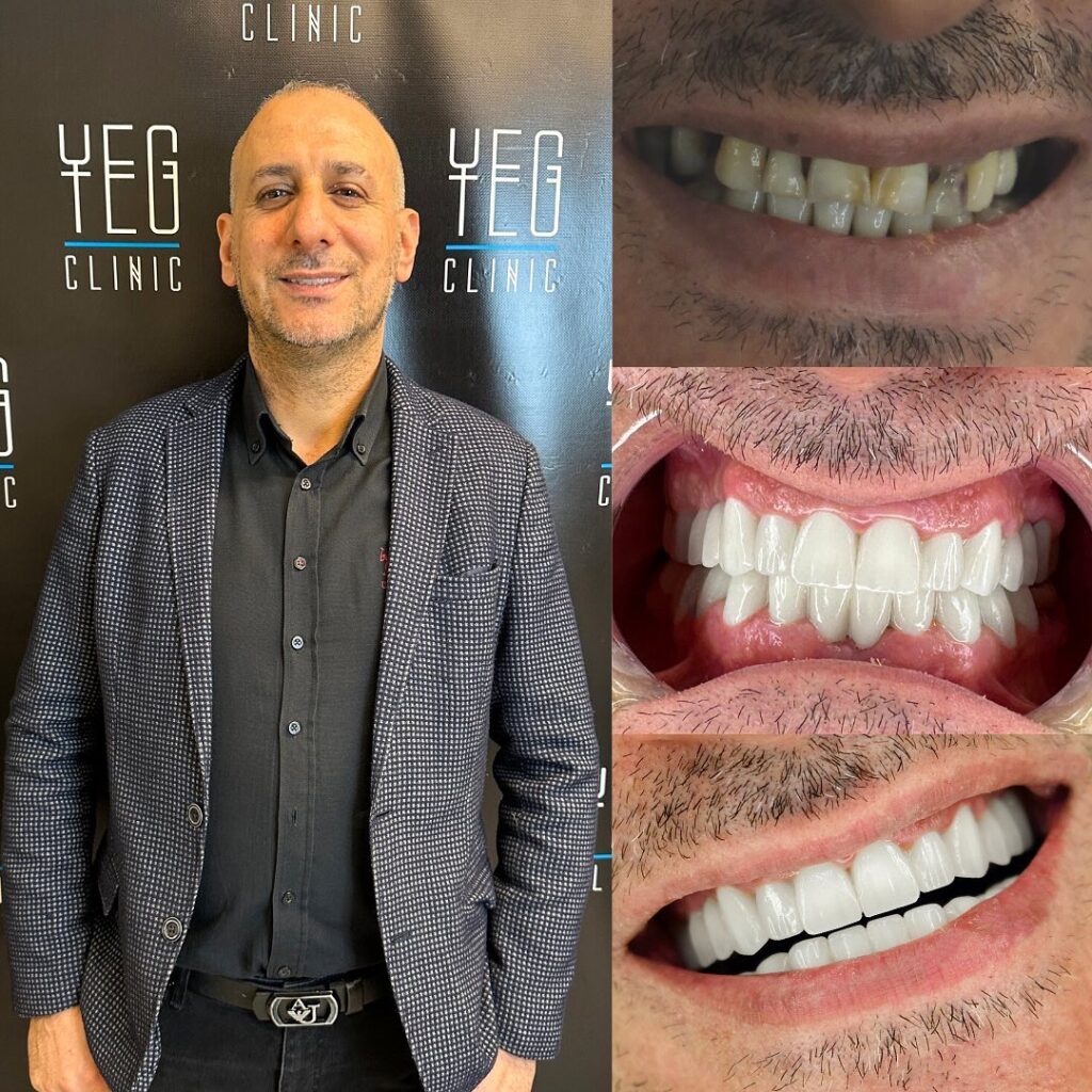Лечение зубов в Турции