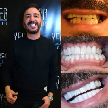 Implants dentaires, Hollywood Smile
