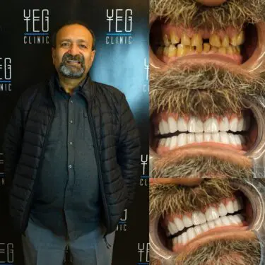 Implants dentaires, Hollywood Smile