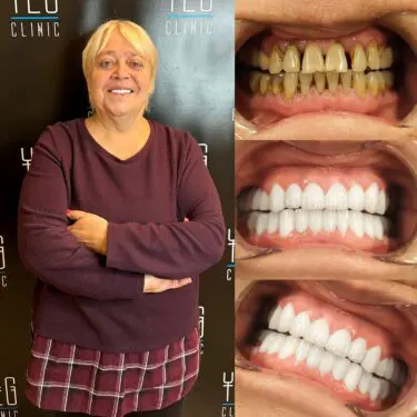 Implants dentaires, Hollywood Smile