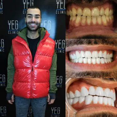 Implants dentaires, Hollywood Smile