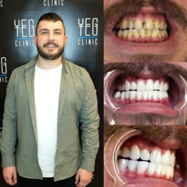 Tratamiento dental en Turquía