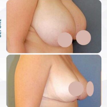 Reducción de mamas en Turquía