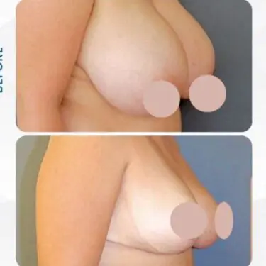 Breast reduction in Turkey