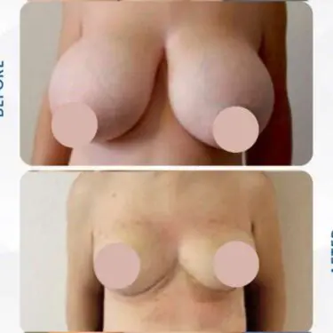 Breast reduction in Turkey
