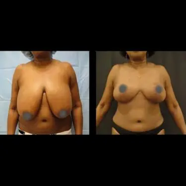 Breast reduction in Turkey