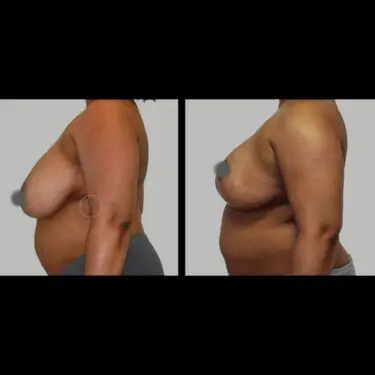 Breast reduction in Turkey