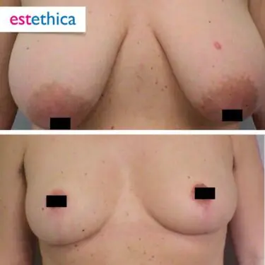 Breast reduction in Turkey