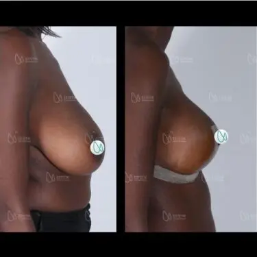 Breast reduction in Turkey