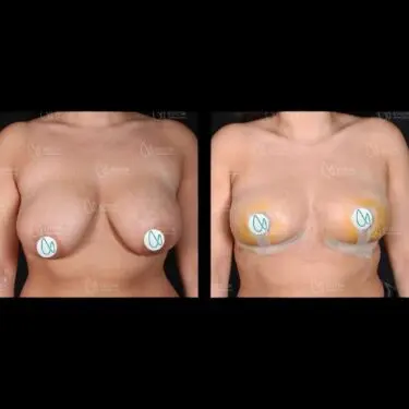 Breast reduction in Turkey