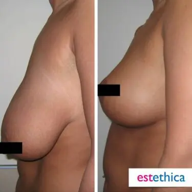 Breast reduction in Turkey