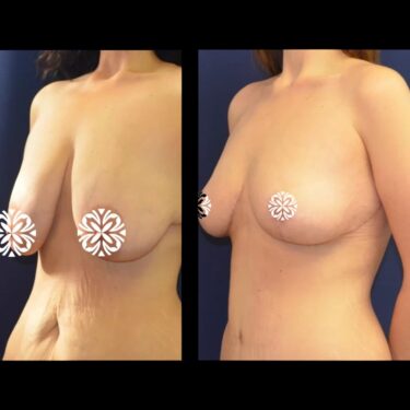 Breast reduction in Turkey