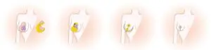 reduction in breast size