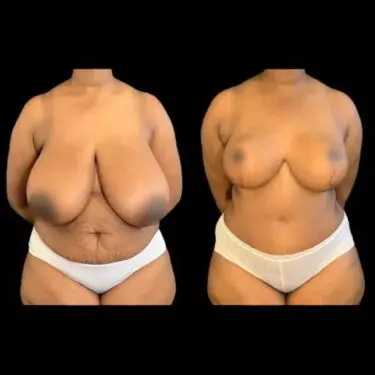 Breast reduction in Turkey