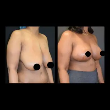 Breast reduction in Turkey