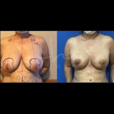 Breast reduction in Turkey