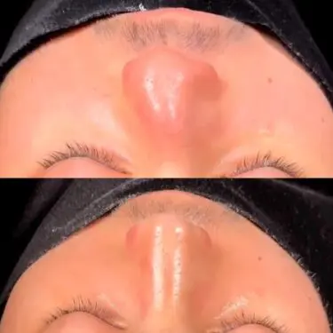 Rhinoplastik