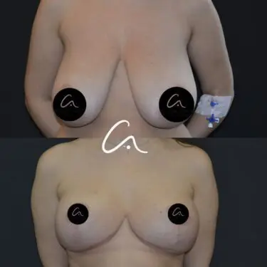 Mammoplastik