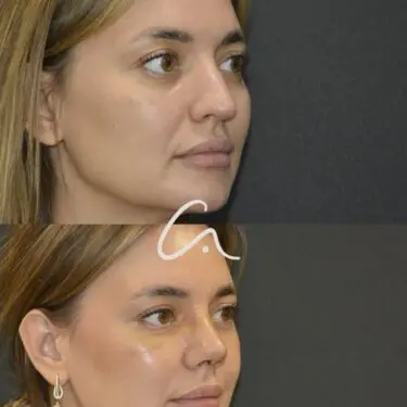 Rhinoplastik