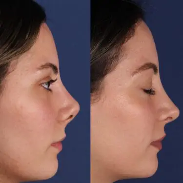 Rhinoplastik
