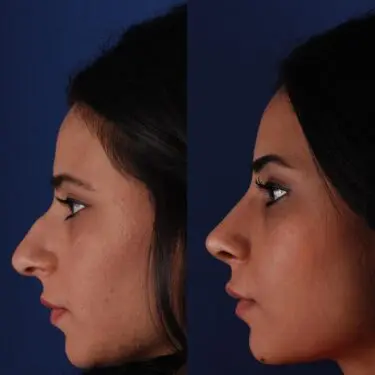 Rhinoplastik