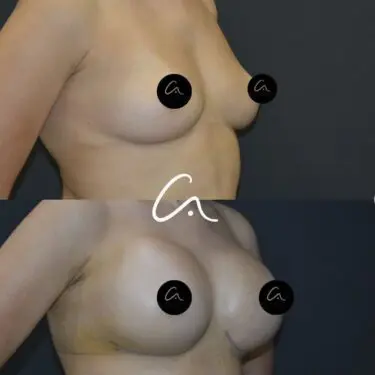 Mammoplastik