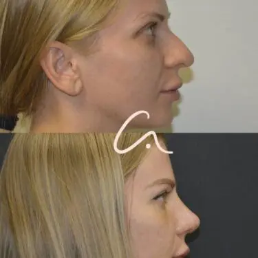 Rhinoplastik