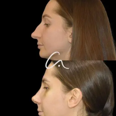 Rhinoplastik