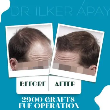 Hair transplantation