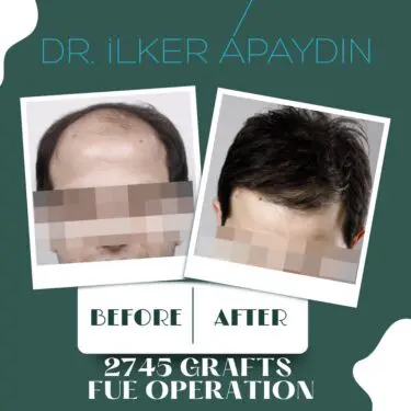 Hair transplantation